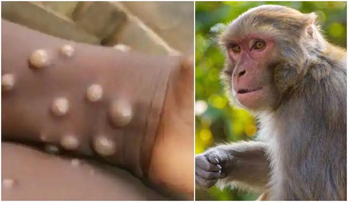 Bộ Y tế ban hành hướng dẫn chẩn đoán, điều trị và phòng bệnh đậu mùa khỉ ở người